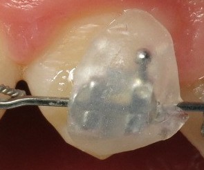 la cire orthodontique est efficace.